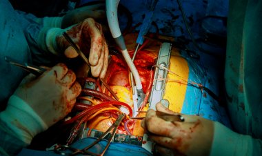 Top Companies in Transcatheter Aortic Valve Replacement Market by Size, Share, Historical and Future Data & CAGR | Report by Vantage Market Research