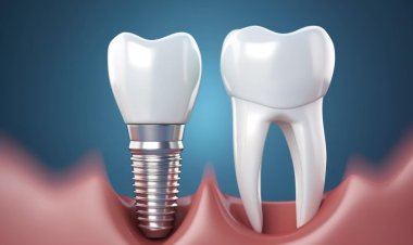 El tamaño del mercado mundial de implantes dentales alcanzará los $ 97.7 mil millones a una CAGR del 6.1% para 2030