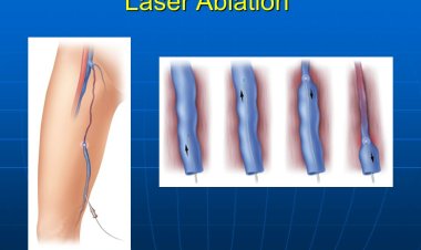 Ablation Laser Systems Market Size Insights and Future Growth Trends: 2024-2032