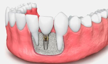 Dental Bone Graft Substitute Market 2024: Analysis by Current Insights, Future Dynamics and Innovative Strategies by 2032