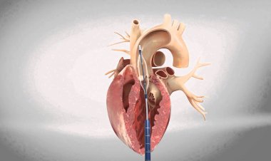 Transcatheter Aortic Valve Replacement (TAVR) Market Size, Analytical Overview, Growth Factors, Demand and Trends Forecast to 2032