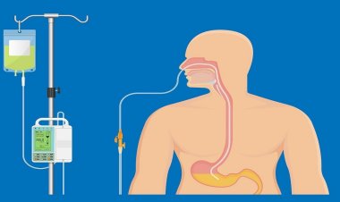 Top Trends Shaping the Enteral Feeding Devices Market in 2025
