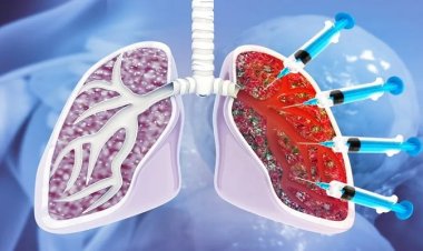 Global Interstitial Lung Disease (ILD) Treatment Market – Trends, Innovations & Growth Opportunities
