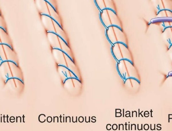 Surgical Sutures Market Size, Share & Trends Analysis Report 2025–2035