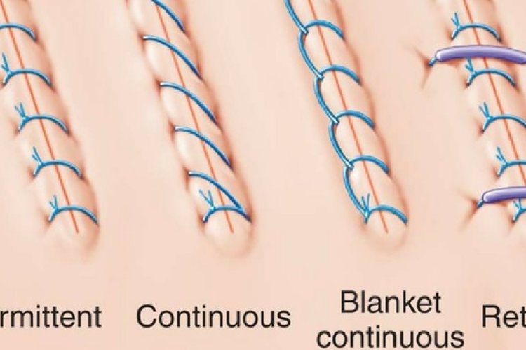 Surgical Sutures Market Size, Share & Trends Analysis Report 2025–2035